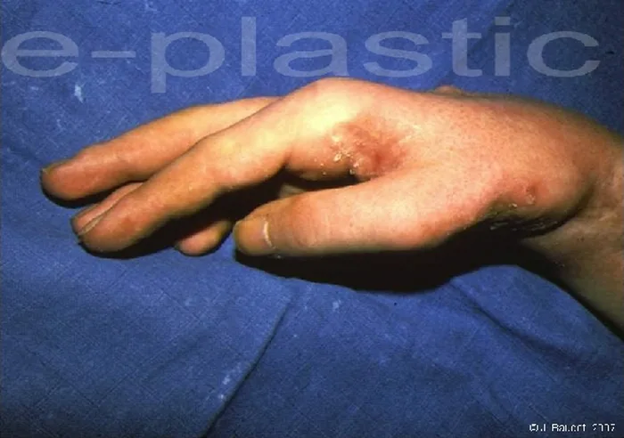 Lambeau parascapulaire — figure 12
