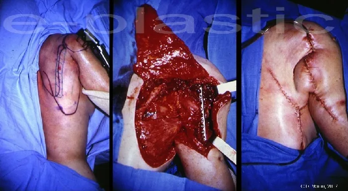 Lambeau parascapulaire — figure 15