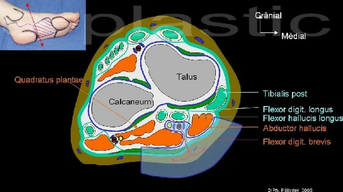 Lambeau plantaire interne — figure 2