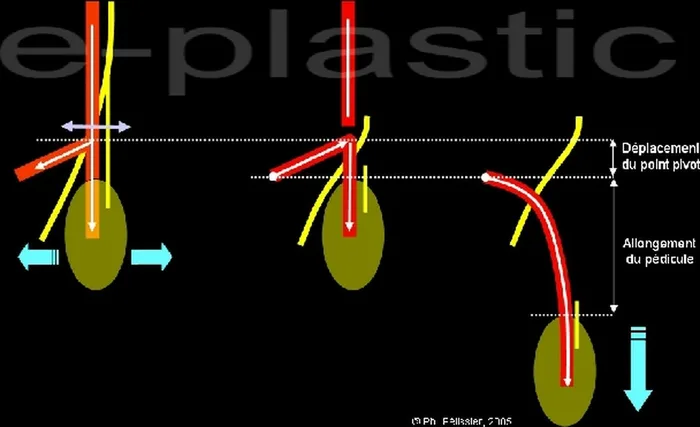 Lambeau plantaire interne — figure 17