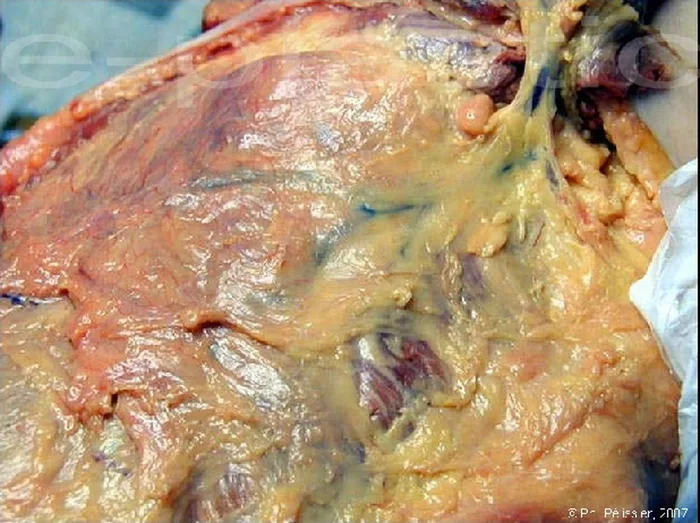 Lambeau de serratus anterior — figure 4