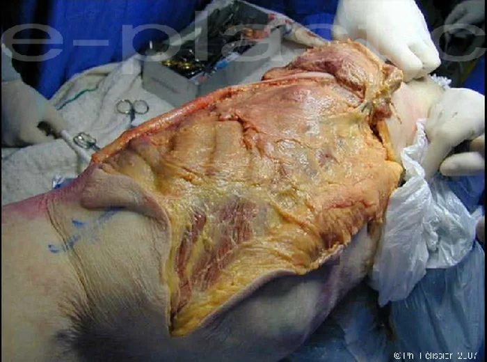 Lambeau de serratus anterior — figure 5