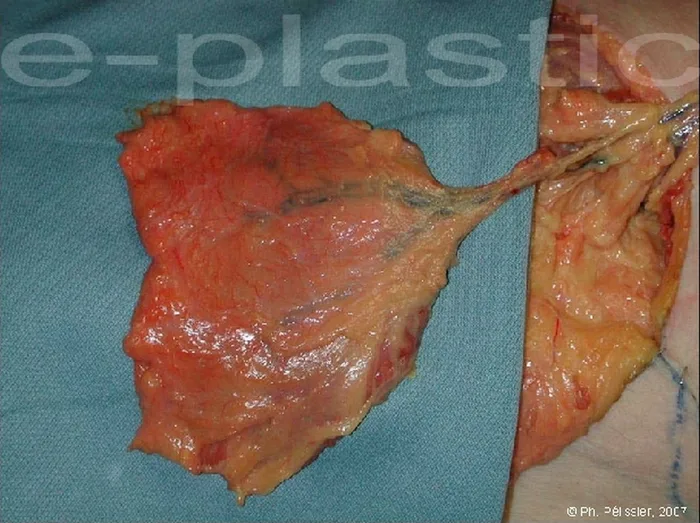 Lambeau de serratus anterior — figure 6