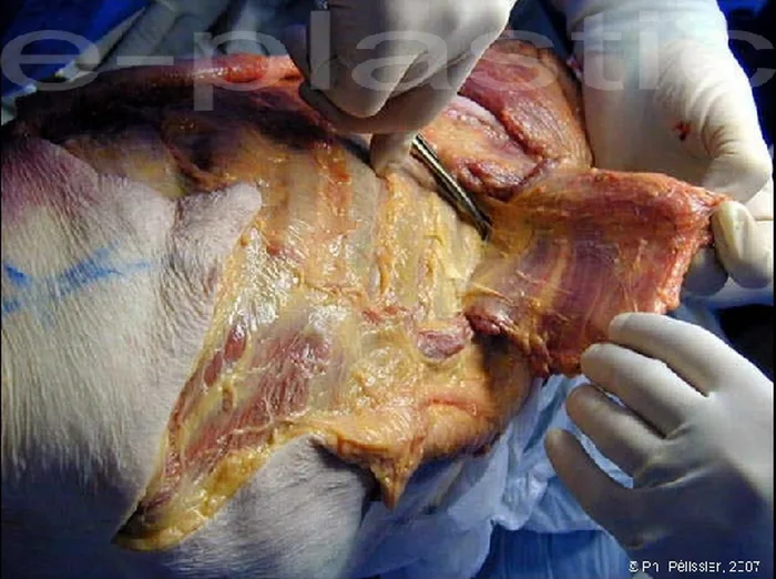 Lambeau de serratus anterior — figure 7