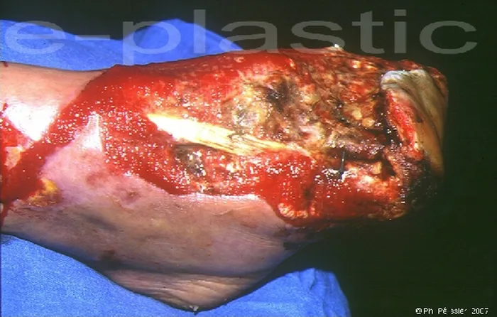 Lambeau de serratus anterior — figure 8