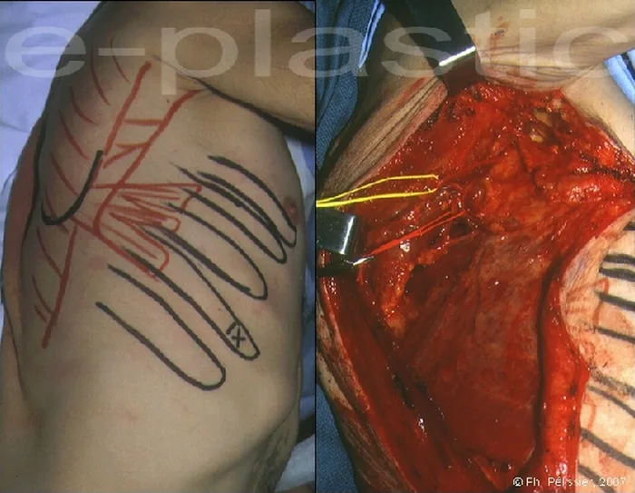 Lambeau de serratus anterior — figure 9
