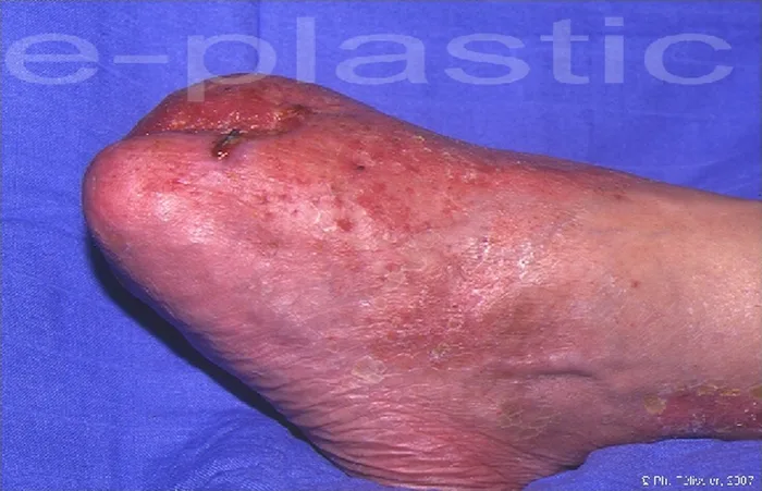 Lambeau de serratus anterior — figure 10