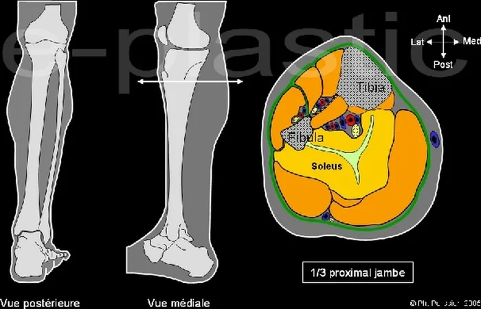 Lambeau de muscle soleus — figure 1