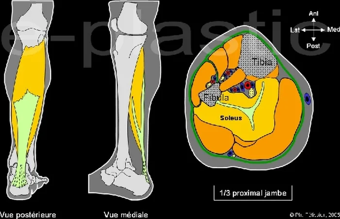 Lambeau de muscle soleus — figure 2