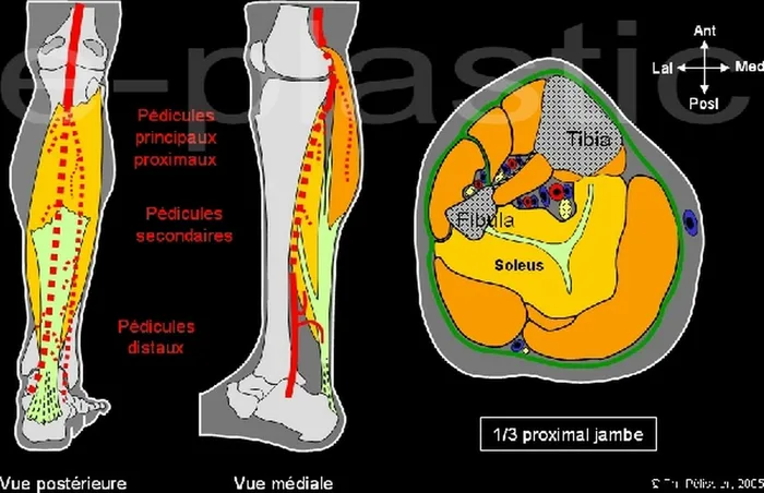 Lambeau de muscle soleus — figure 3