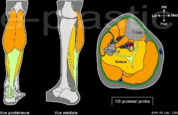 Lambeau de muscle soleus — figure 4