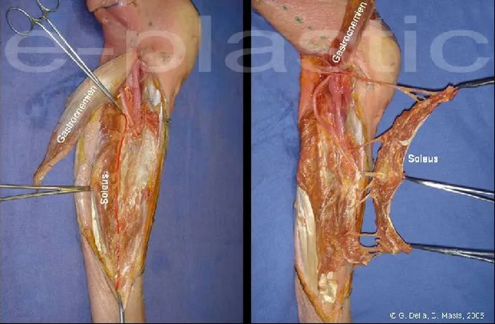 Lambeau de muscle soleus — figure 5