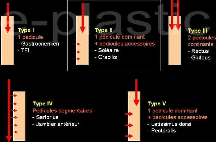 Lambeau de muscle soleus — figure 6