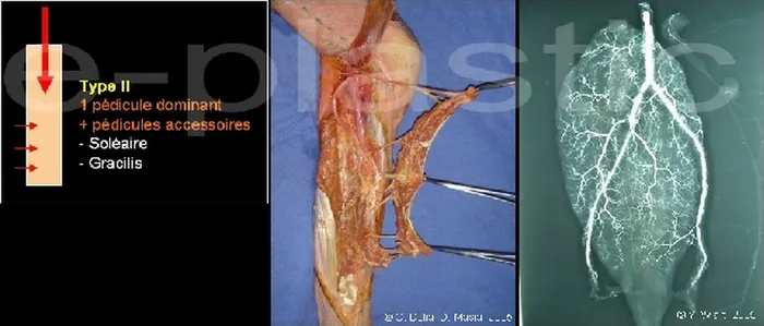 Lambeau de muscle soleus — figure 7