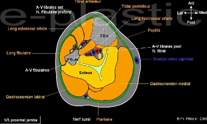 Lambeau de muscle soleus — figure 8