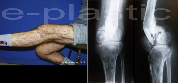 Lambeau de muscle soleus — figure 9