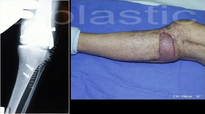 Lambeau de muscle soleus — figure 10