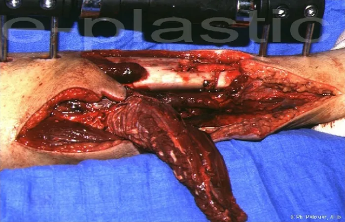 Lambeau de muscle soleus — figure 12