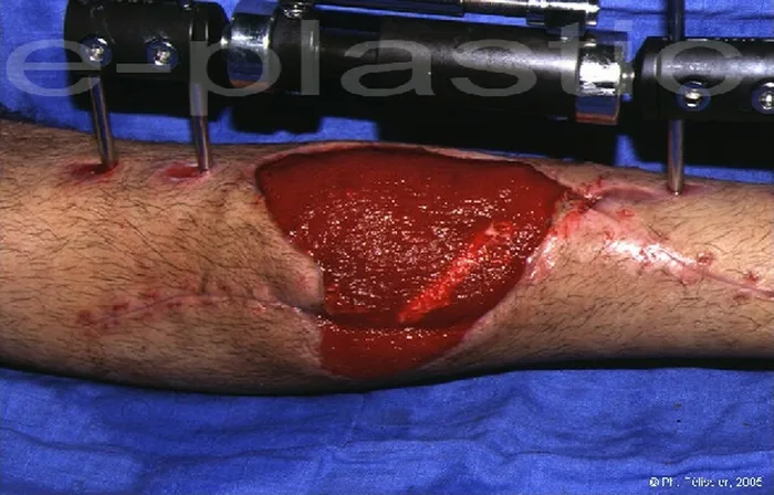 Lambeau de muscle soleus — figure 13