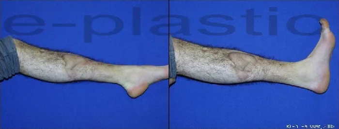 Lambeau de muscle soleus — figure 14