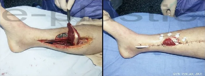 Lambeau de muscle soleus — figure 15