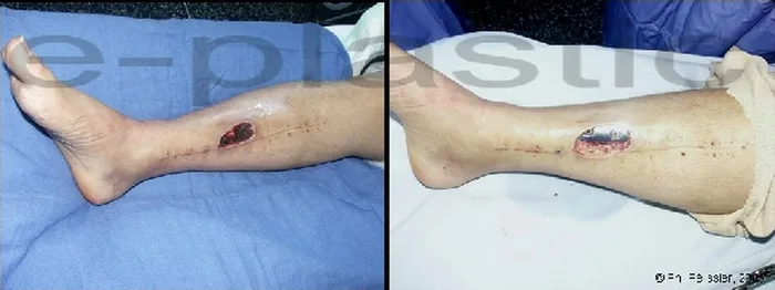 Lambeau de muscle soleus — figure 16