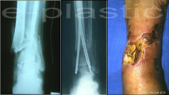 Lambeau de muscle soleus — figure 17
