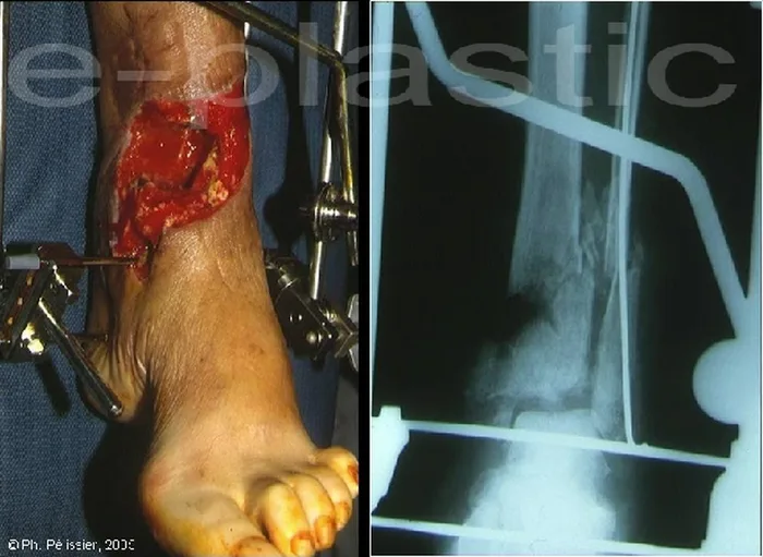 Lambeau de muscle soleus — figure 19