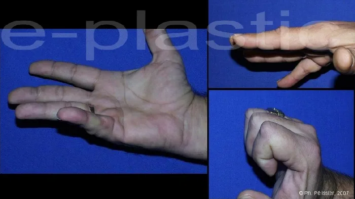 Maladie de Dupuytren — figure 1