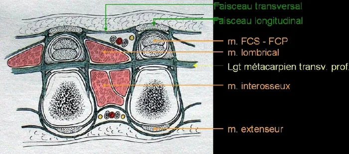 Maladie de Dupuytren — figure 4