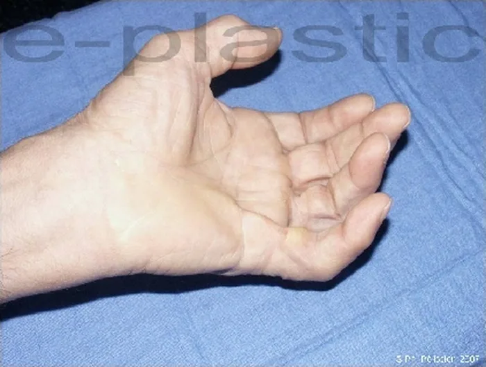 Maladie de Dupuytren — figure 10