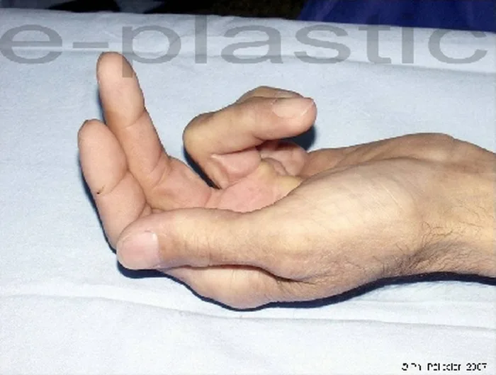 Maladie de Dupuytren — figure 15