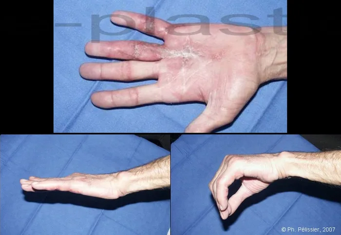 Maladie de Dupuytren — figure 21