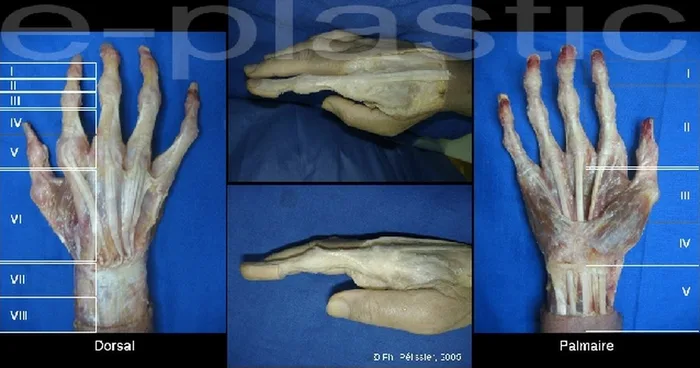 Séquelles tendineuses — figure 1