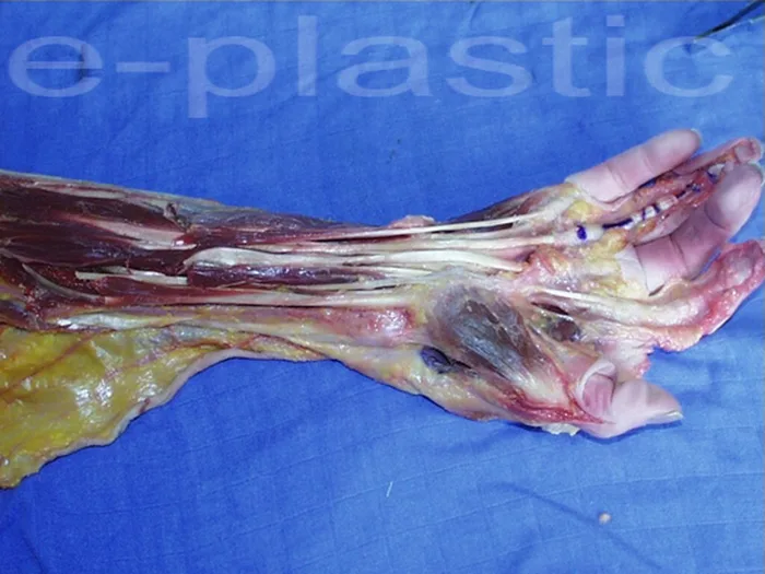 Séquelles tendineuses — figure 2