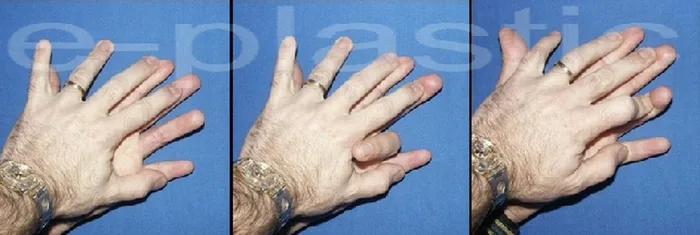 Séquelles tendineuses — figure 3