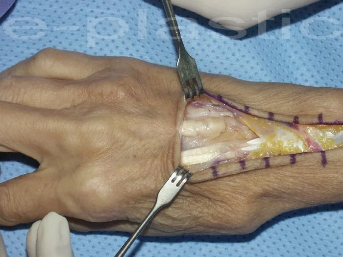 Séquelles tendineuses — figure 4