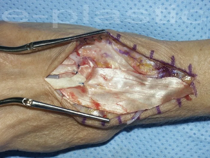 Séquelles tendineuses — figure 5