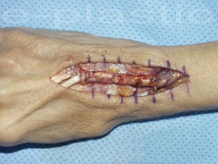 Séquelles tendineuses — figure 6