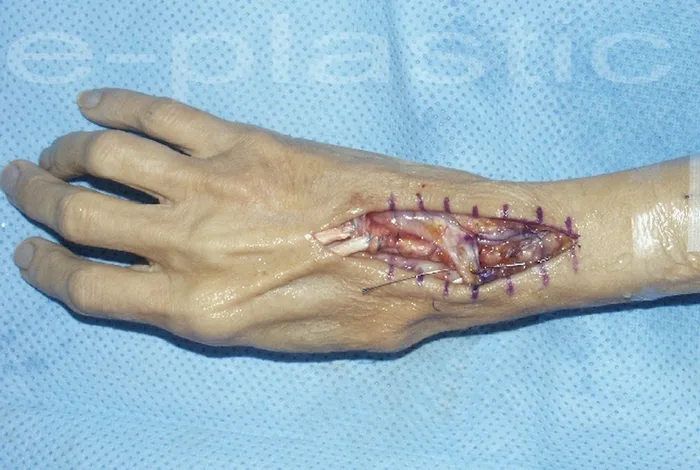 Séquelles tendineuses — figure 7