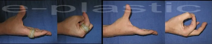 Séquelles tendineuses — figure 15
