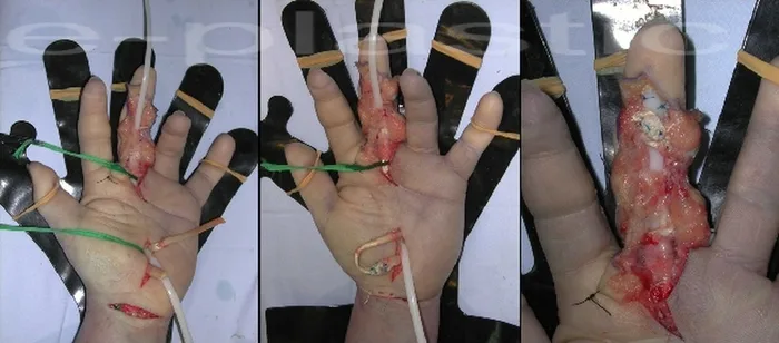 Séquelles tendineuses — figure 16