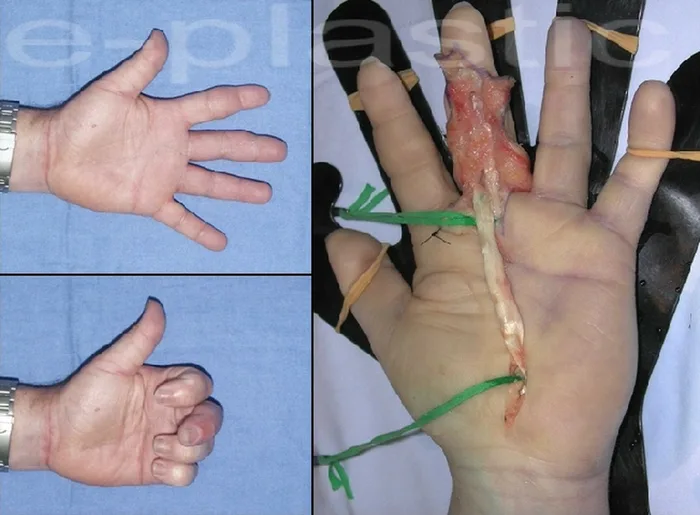 Séquelles tendineuses — figure 17