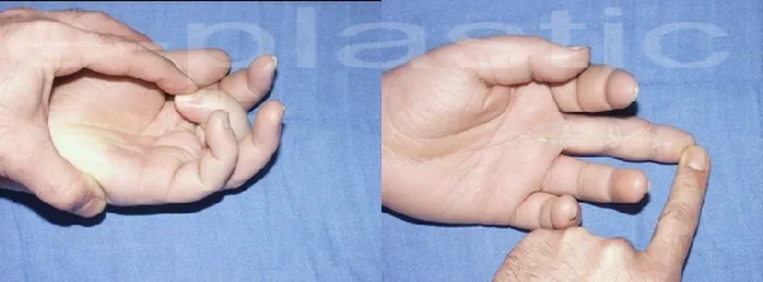 Séquelles tendineuses — figure 18