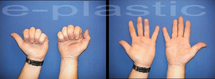 Séquelles tendineuses — figure 19