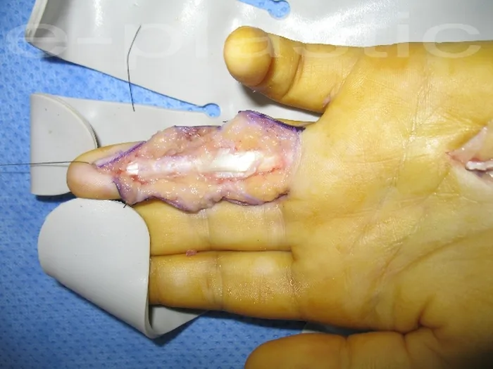 Séquelles tendineuses — figure 20