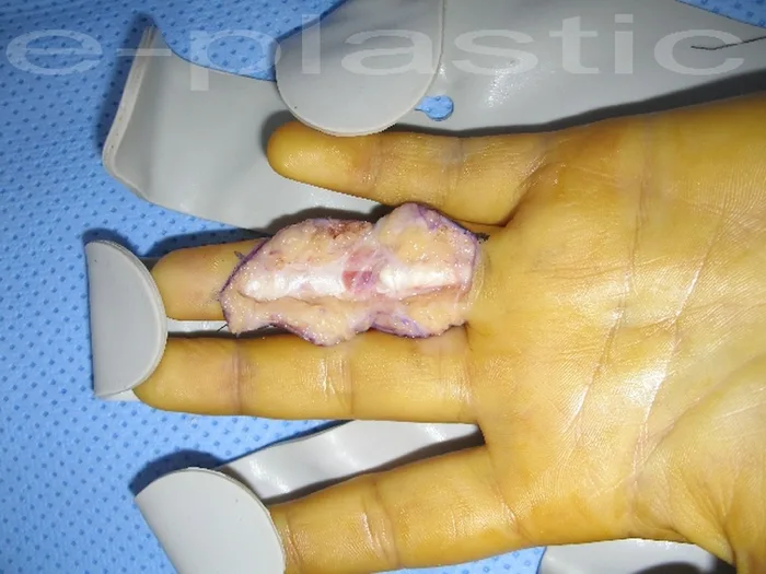 Séquelles tendineuses — figure 21