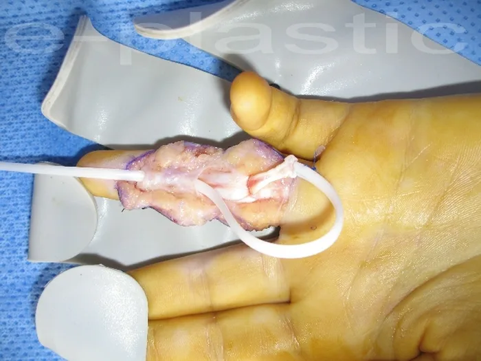 Séquelles tendineuses — figure 22