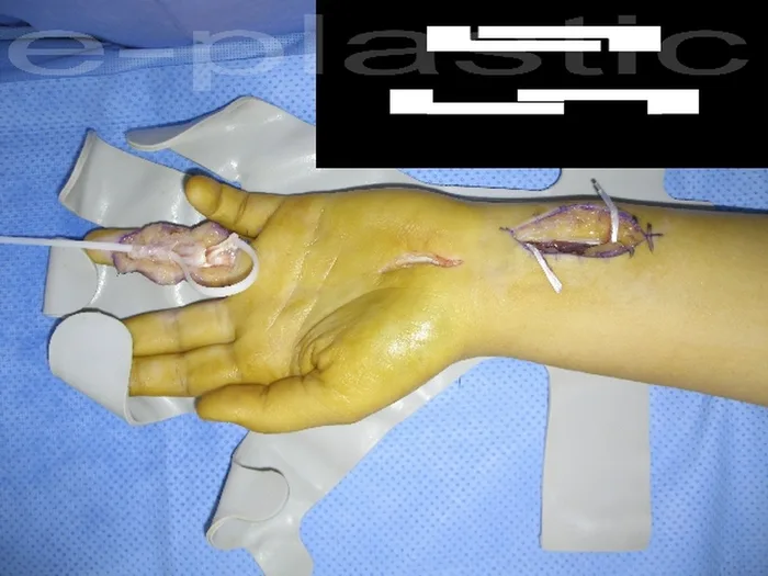 Séquelles tendineuses — figure 23