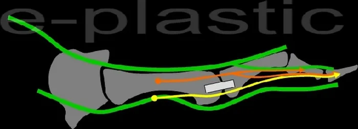 Séquelles tendineuses — figure 25